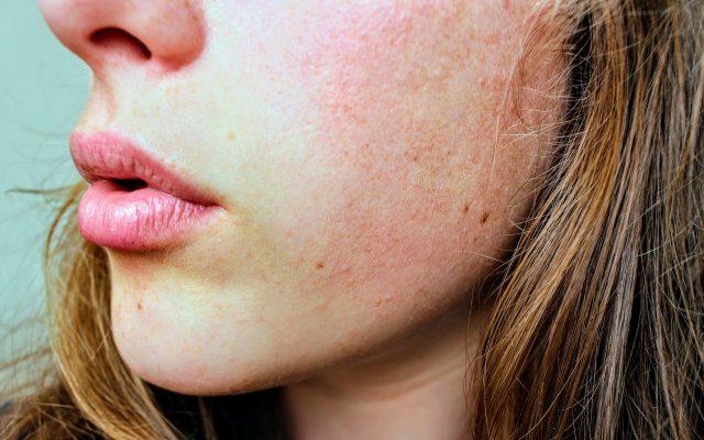 substance-abuse-effects-on-skin-epidermis-drugs-addiction